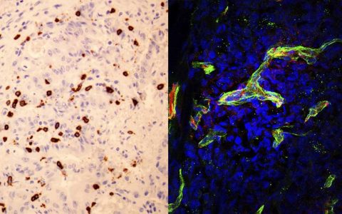 Izquierda: Linfocitos citotóxicos (en marrón) infiltrando un tumor colorectal con altos niveles de SOD3. Derecha: Células tumorales (cuyos núcleos se muestran en azul) con los vasos sanguíneos que los irrigan (en rojo) donde se observa la proteína de la membrana basal (en verde) que permite que los linfocitos accedan al tumor. / CNB